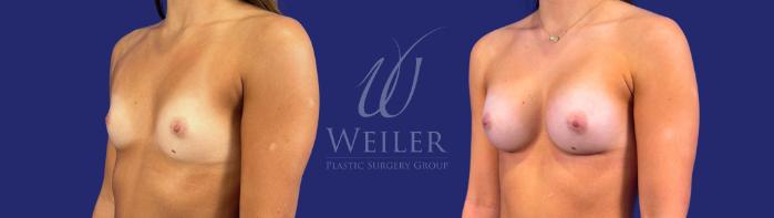 Before & After Breast Augmentation Case 1699 Left Oblique View in Baton Rouge, New Orleans, & Lafayette, Louisiana