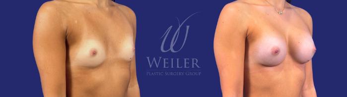 Before & After Breast Augmentation Case 1699 Right Oblique View in Baton Rouge, New Orleans, & Lafayette, Louisiana