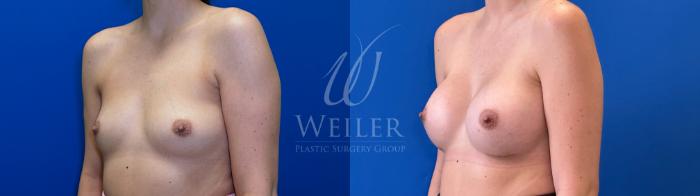 Before & After Breast Augmentation Case 1712 Left Oblique View in Baton Rouge, New Orleans, & Lafayette, Louisiana