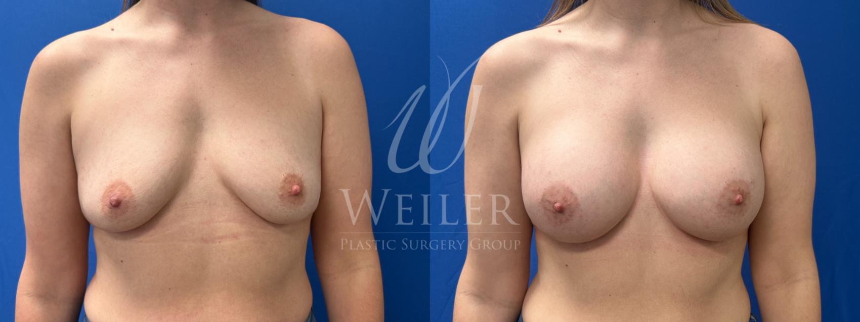 Before & After Breast Augmentation Case 1714 Front View in Baton Rouge, New Orleans, & Lafayette, Louisiana