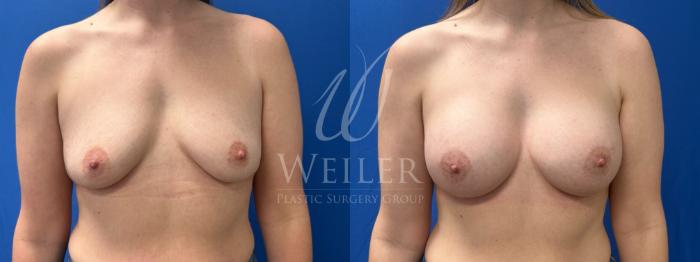 Before & After Breast Augmentation Case 1714 Front View in Baton Rouge, New Orleans, & Lafayette, Louisiana