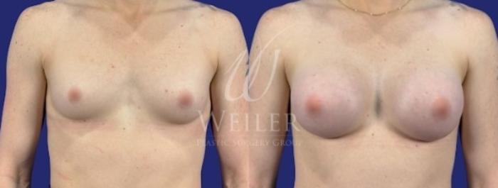 Before & After Breast Augmentation Case 1723 Front View in Baton Rouge, New Orleans, & Lafayette, Louisiana