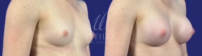 Before & After Breast Augmentation Case 1723 Right Oblique View in Baton Rouge, New Orleans, & Lafayette, Louisiana