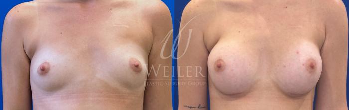 Before & After Breast Augmentation Case 1725 Front View in Baton Rouge, New Orleans, & Lafayette, Louisiana
