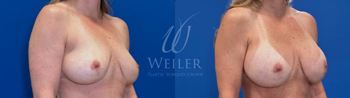 Before & After Breast Augmentation Case 1731 Right Oblique View in Baton Rouge, New Orleans, & Lafayette, Louisiana