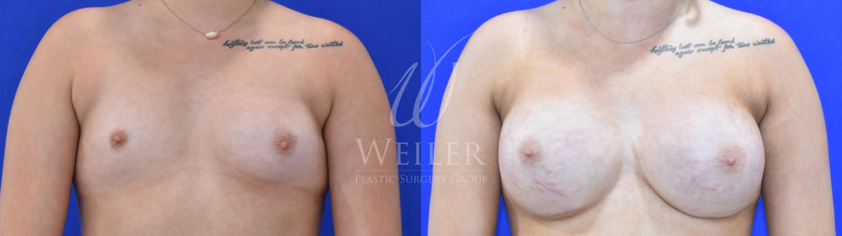 Before & After Breast Augmentation Case 1734 Front View in Baton Rouge, New Orleans, & Lafayette, Louisiana