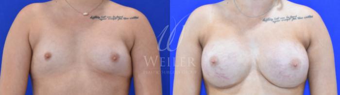 Before & After Breast Augmentation Case 1734 Front View in Baton Rouge, New Orleans, & Lafayette, Louisiana