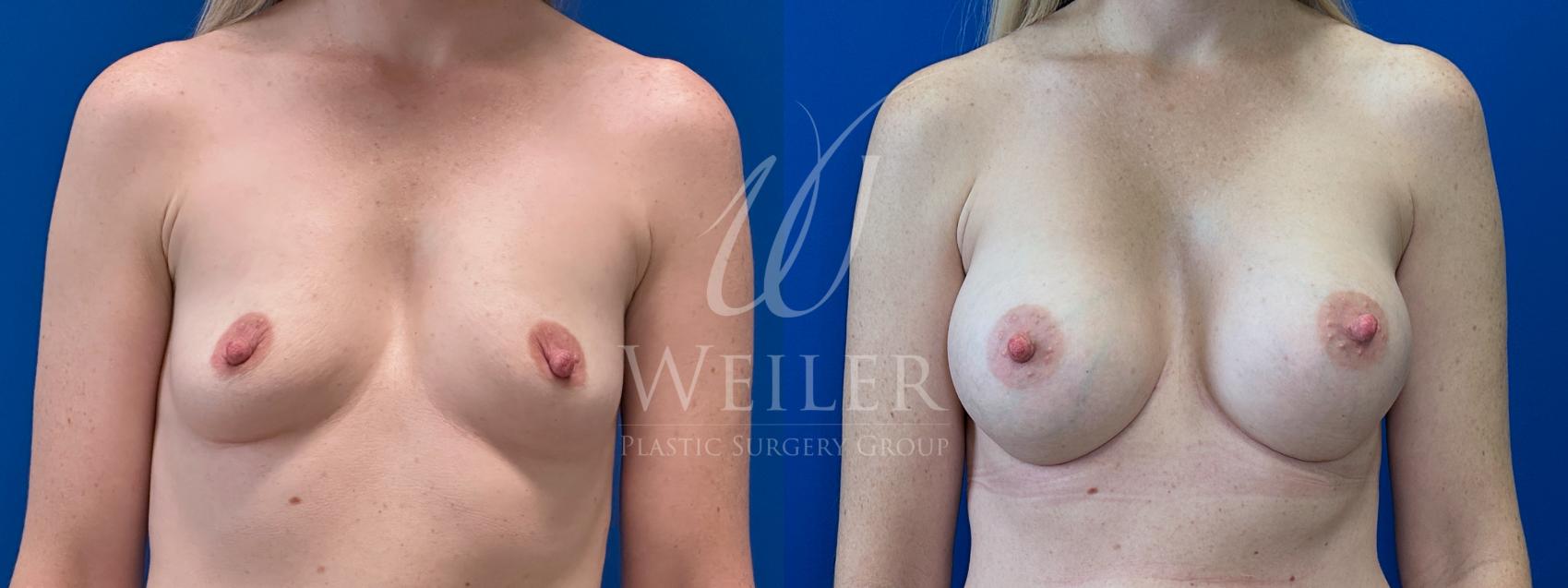 Before & After Breast Augmentation Case 1739 Front View in Baton Rouge, New Orleans, & Lafayette, Louisiana