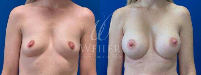 Before & After Breast Augmentation Case 1739 Front View in Baton Rouge, New Orleans, & Lafayette, Louisiana
