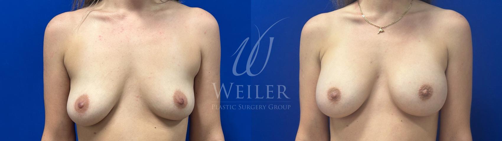 Before & After Breast Augmentation Case 1740 Front View in Baton Rouge, New Orleans, & Lafayette, Louisiana