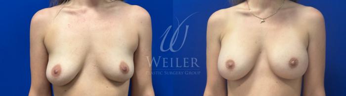 Before & After Breast Augmentation Case 1740 Front View in Baton Rouge, New Orleans, & Lafayette, Louisiana