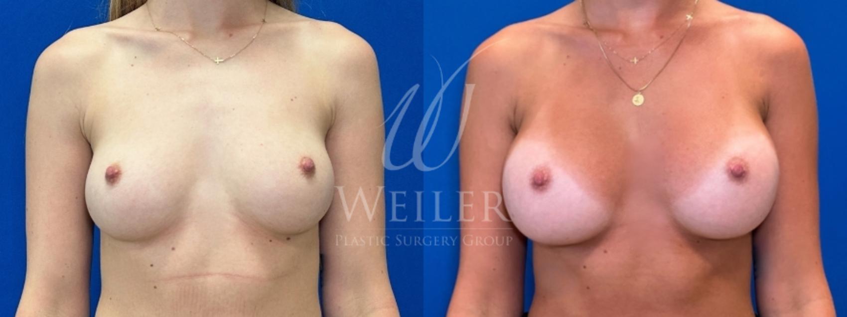 Before & After Breast Augmentation Case 1749 Front View in Baton Rouge, New Orleans, & Lafayette, Louisiana