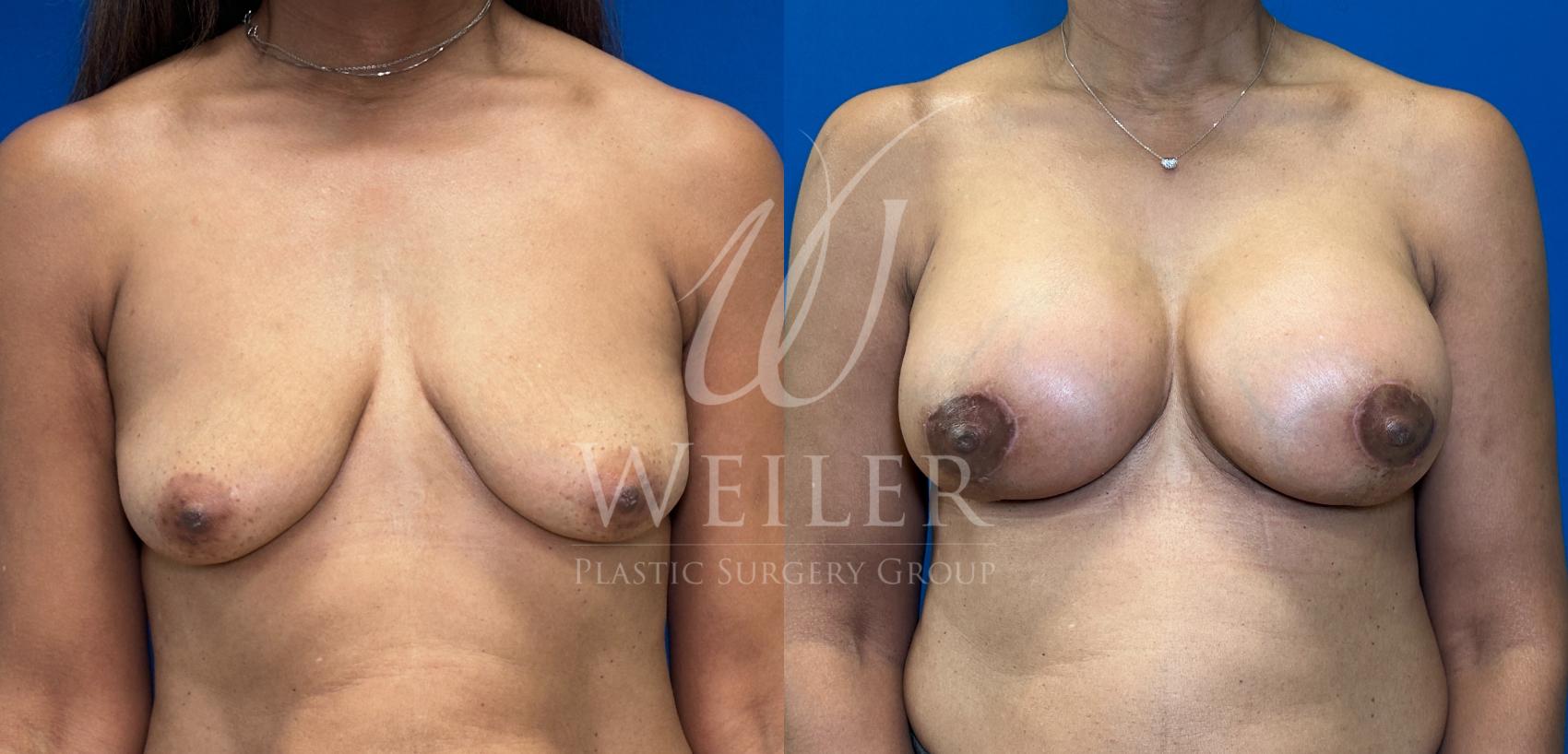 Before & After Breast Augmentation Case 1762 Front View in Baton Rouge, New Orleans, & Lafayette, Louisiana