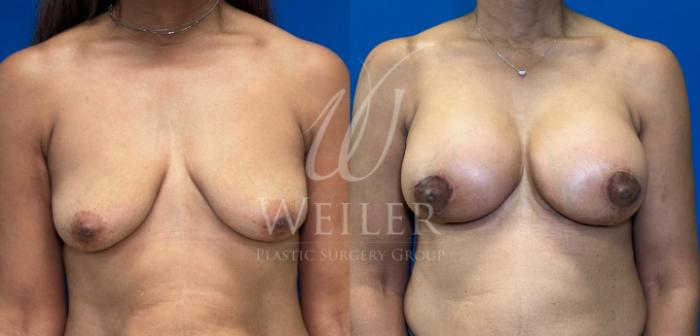 Before & After Breast Augmentation Case 1762 Front View in Baton Rouge, New Orleans, & Lafayette, Louisiana