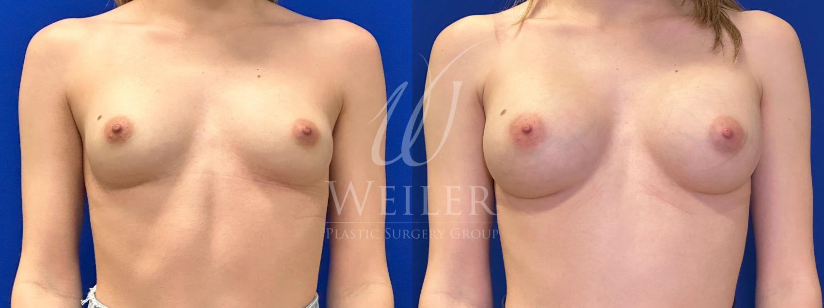 Before & After Breast Augmentation Case 1764 Front View in Baton Rouge, New Orleans, & Lafayette, Louisiana
