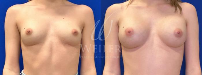 Before & After Breast Augmentation Case 1764 Front View in Baton Rouge, New Orleans, & Lafayette, Louisiana