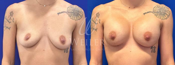 Before & After Breast Augmentation Case 1766 Front View in Baton Rouge, New Orleans, & Lafayette, Louisiana