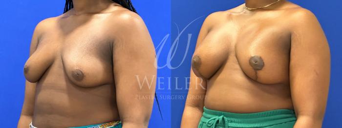 Before & After Breast Augmentation Case 1767 Left Oblique View in Baton Rouge, New Orleans, & Lafayette, Louisiana