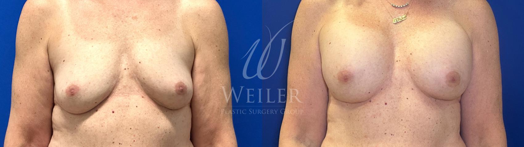 Before & After Breast Augmentation Case 1769 Front View in Baton Rouge, New Orleans, & Lafayette, Louisiana