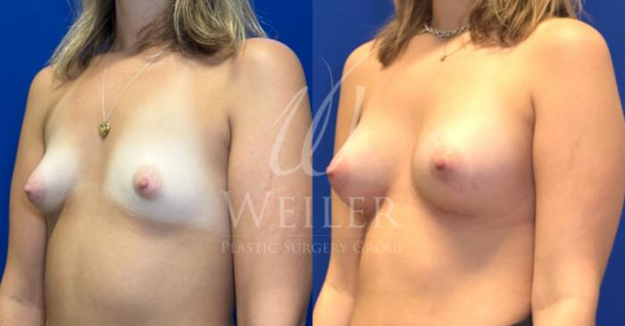 Before & After Breast Augmentation Case 1774 Right Oblique View in Baton Rouge, New Orleans, & Lafayette, Louisiana