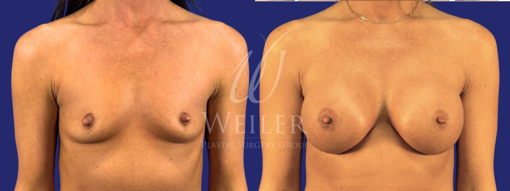 Before & After Breast Augmentation Case 1788 Front View in Baton Rouge, New Orleans, & Lafayette, Louisiana