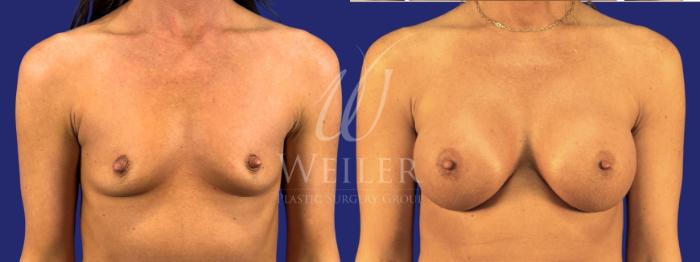 Before & After Breast Augmentation Case 1788 Front View in Baton Rouge, New Orleans, & Lafayette, Louisiana