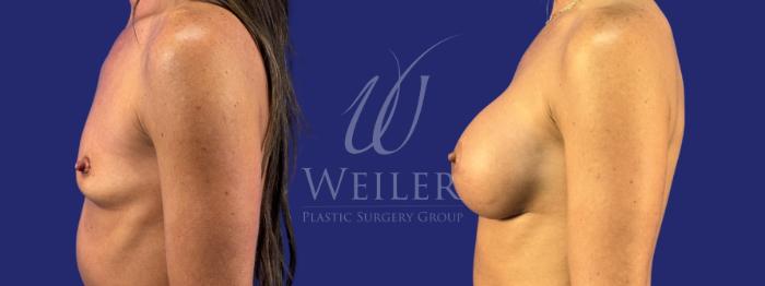 Before & After Breast Augmentation Case 1788 Left Side View in Baton Rouge, New Orleans, & Lafayette, Louisiana
