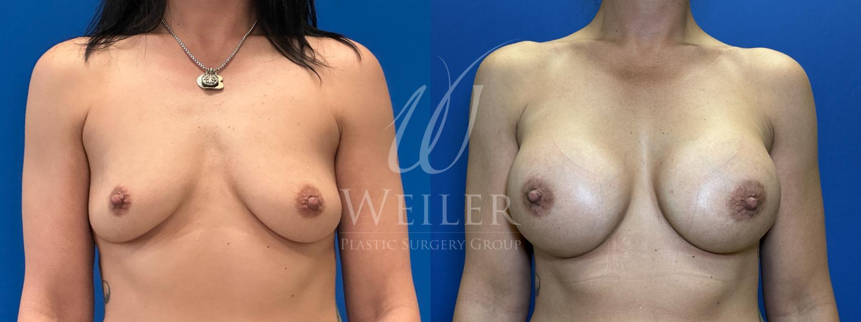 Before & After Breast Augmentation Case 1800 Front View in Baton Rouge, New Orleans, & Lafayette, Louisiana