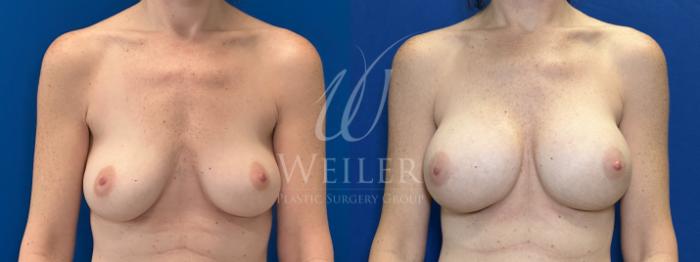 Before & After Breast Augmentation Case 1801 Front View in Baton Rouge, New Orleans, & Lafayette, Louisiana