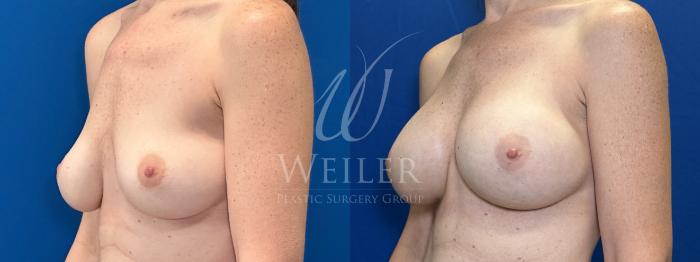 Before & After Breast Augmentation Case 1801 Left Oblique View in Baton Rouge, New Orleans, & Lafayette, Louisiana