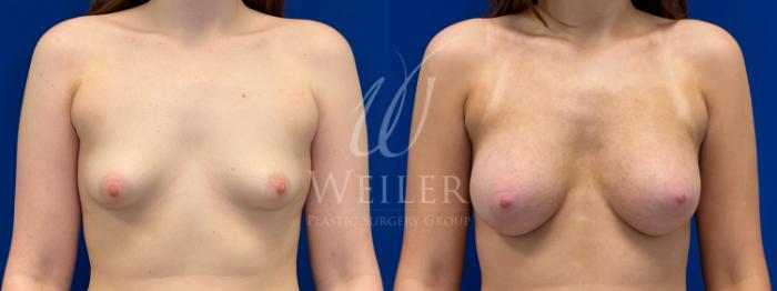 Before & After Breast Augmentation Case 1802 Front View in Baton Rouge, New Orleans, & Lafayette, Louisiana