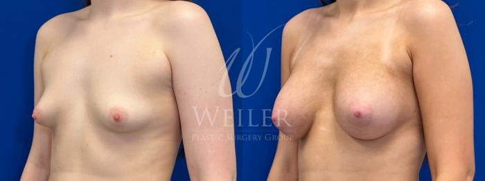 Before & After Breast Augmentation Case 1802 Left Oblique View in Baton Rouge, New Orleans, & Lafayette, Louisiana