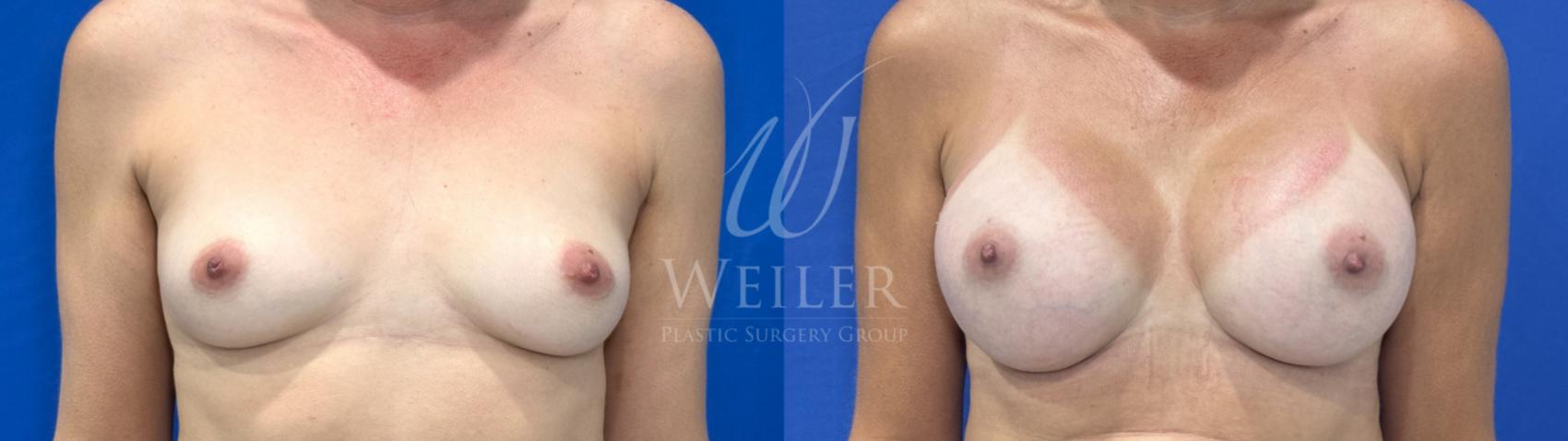 Before & After Breast Augmentation Case 1816 Front View in Baton Rouge, New Orleans, & Lafayette, Louisiana