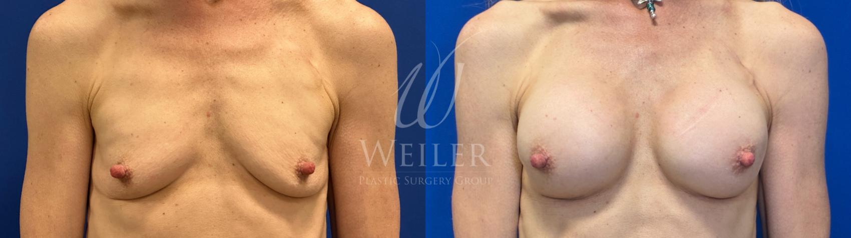 Before & After Breast Augmentation Case 1817 Front View in Baton Rouge, New Orleans, & Lafayette, Louisiana