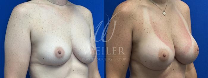 Before & After Breast Augmentation Case 1818 Right Oblique View in Baton Rouge, New Orleans, & Lafayette, Louisiana