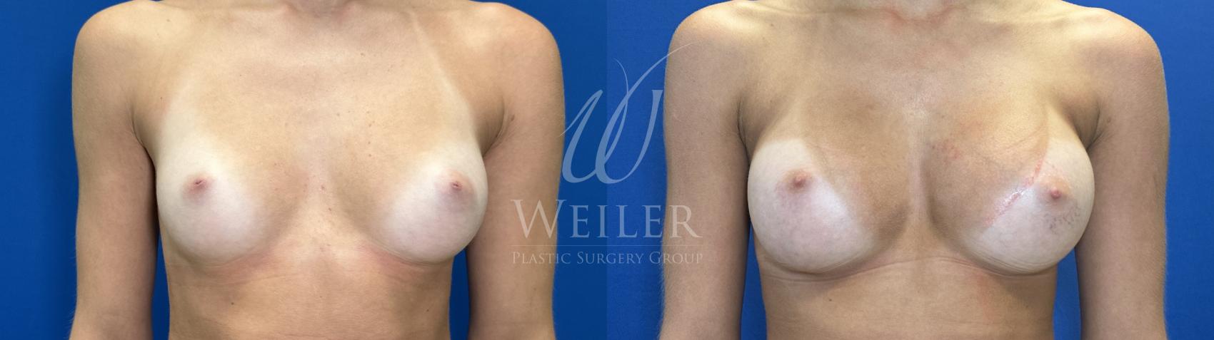 Before & After Breast Augmentation Case 1823 Front View in Baton Rouge, New Orleans, & Lafayette, Louisiana