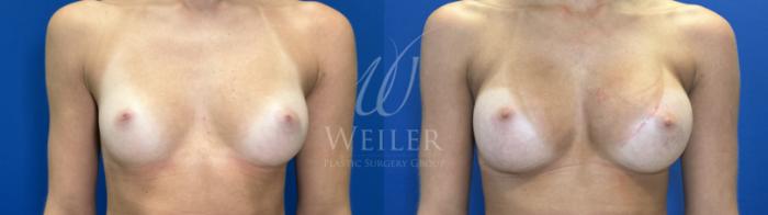 Before & After Breast Augmentation Case 1823 Front View in Baton Rouge, New Orleans, & Lafayette, Louisiana