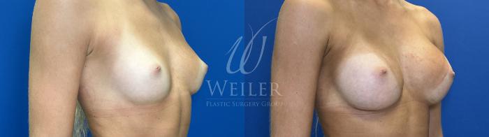 Before & After Breast Augmentation Case 1823 Right Oblique View in Baton Rouge, New Orleans, & Lafayette, Louisiana
