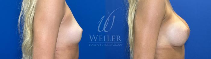 Before & After Breast Augmentation Case 1823 Right Side View in Baton Rouge, New Orleans, & Lafayette, Louisiana