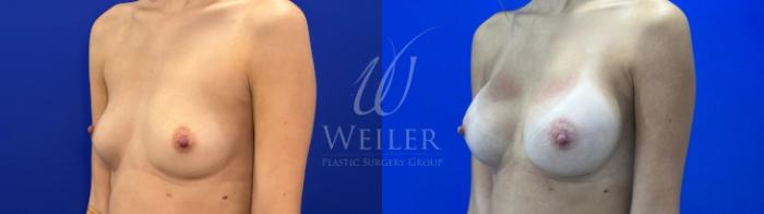 Before & After Breast Augmentation Case 1825 Left Oblique View in Baton Rouge, New Orleans, & Lafayette, Louisiana
