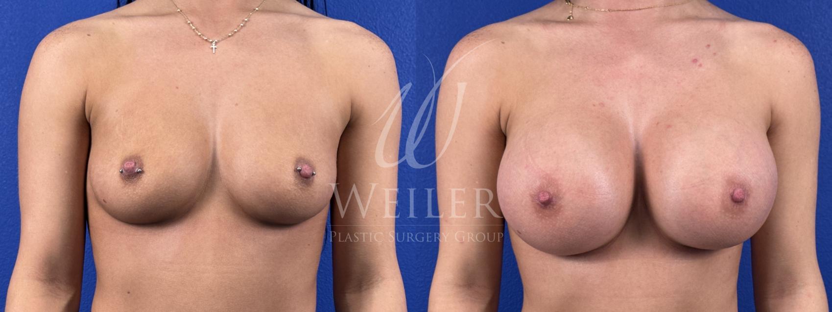 Before & After Breast Augmentation Case 1826 Front View in Baton Rouge, New Orleans, & Lafayette, Louisiana