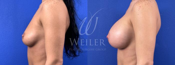 Before & After Breast Augmentation Case 1826 Left Side View in Baton Rouge, New Orleans, & Lafayette, Louisiana