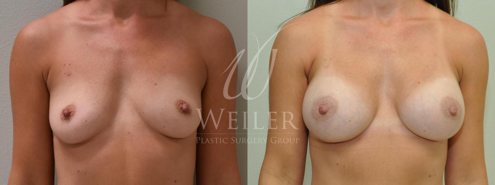 Before & After Breast Augmentation Case 186 View #1 View in Baton Rouge, New Orleans, & Lafayette, Louisiana