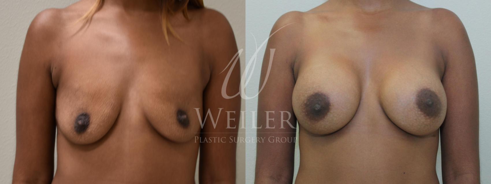 Before & After Breast Augmentation Case 191 View #1 View in Baton Rouge, New Orleans, & Lafayette, Louisiana