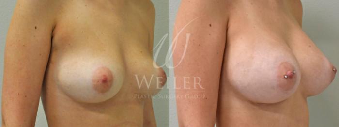 Before & After Breast Augmentation Case 192 View #1 View in Baton Rouge, New Orleans, & Lafayette, Louisiana