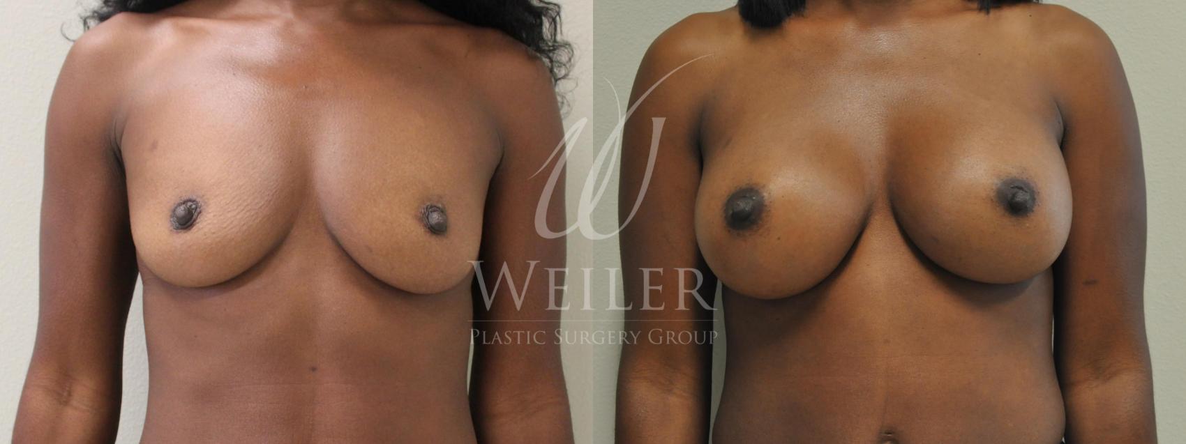 Before & After Breast Augmentation Case 195 View #1 View in Baton Rouge, Louisiana