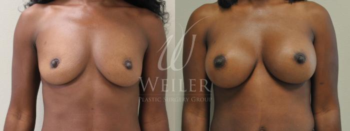 Before & After Breast Augmentation Case 195 View #1 View in Baton Rouge, New Orleans, & Lafayette, Louisiana