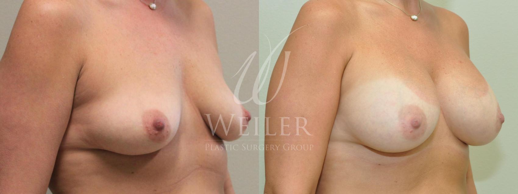 Before & After Breast Augmentation Case 202 View #1 View in Baton Rouge, New Orleans, & Lafayette, Louisiana