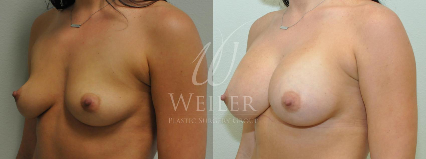 Before & After Breast Augmentation Case 209 View #1 View in Baton Rouge, New Orleans, & Lafayette, Louisiana
