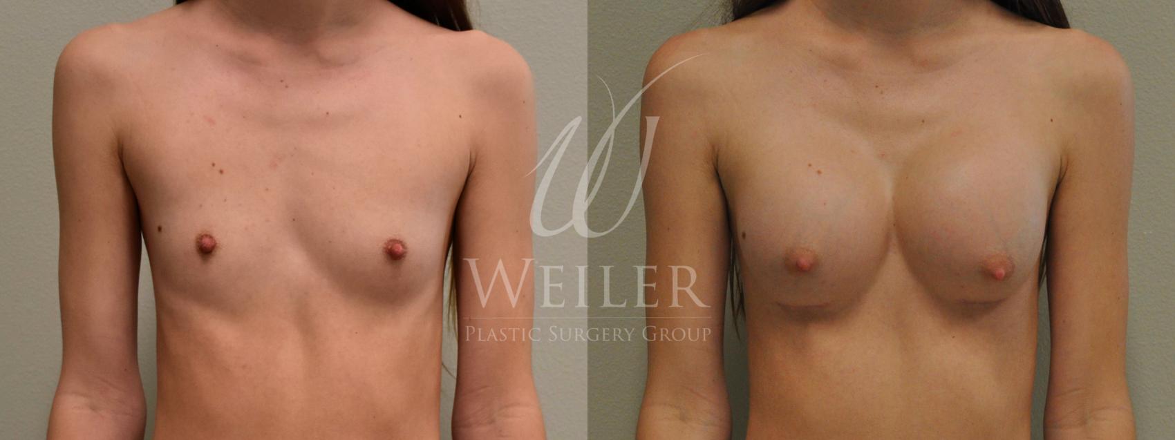 Before & After Breast Augmentation Case 214 View #1 View in Baton Rouge, New Orleans, & Lafayette, Louisiana